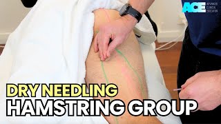 Dry Needling Hamstring Group [upl. by Obau]