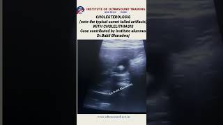 Cholesterolosis with cholelithiasis ultrasound ultrasoundlife pocus [upl. by Ateerys981]