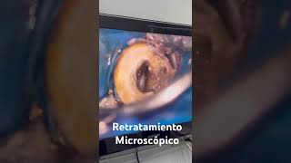 ¿Una endodoncia puede volver a contaminar Retratamiento no quirúrgico endodoncia satisfying [upl. by Leod]