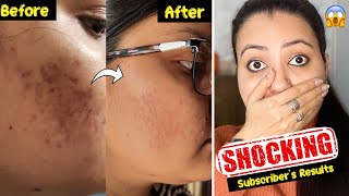 Subscribers Magical Skincare Challenge  Strongest Remedy To Remove Dark SpotsAcne Pimples Marks💕 [upl. by Andras]