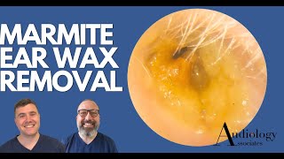 MARMITE EAR WAX REMOVAL EP879 [upl. by Harmony]