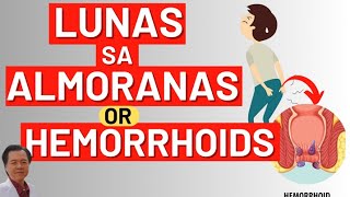 Lunas sa Almoranas or Hemorrhoids  By Doc Willie Ong [upl. by Scholz]