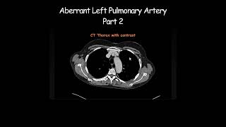 Aberrant Left Pulmonary Artery Part 2 radiology radiologist anatomy [upl. by Ttirrem317]