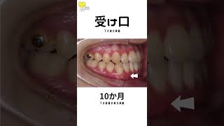 「受け口」をマウスピース矯正！治療経過 shorts 歯医者 dentist [upl. by Xanthe]