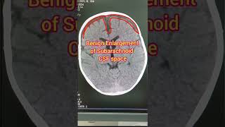 BESS Benign Enlargement of Subarachnoid space [upl. by Enirroc]