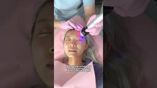 Micro needling vlog👩‍⚕️ microneedling skintreatment beauty [upl. by Flavia]