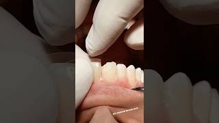 Class IV composite restoration dentist satisfying [upl. by Halehs53]