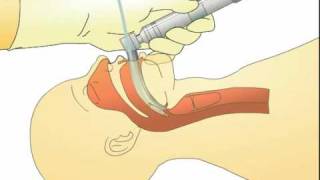 Tracheal Intubation Procedure  Nursing CE [upl. by Yram]