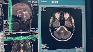 how to make mri orbit protocol and sequence n planning live demo [upl. by Nahs]