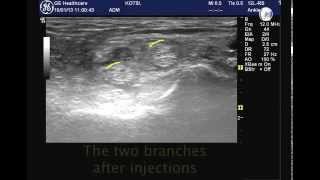 Tibial nerve block [upl. by Egwin]