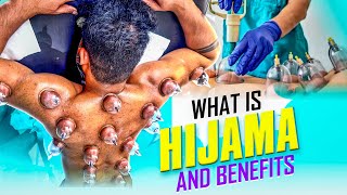 what is hijama cupping and benefits in Telugufull vlog by fitwithajay [upl. by Bose]