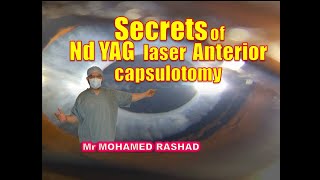 Secrets of Nd YAG Anterior Capsulotomyليزر للمحفظة الأمامية لعدسة العين بعد عملية المياة البيضاء [upl. by Tracay114]