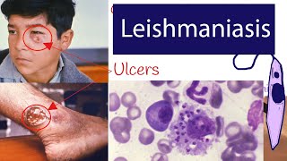 Leishmaniasis  Symptoms and Treatment of Leishmaniasis Explained under 3 minutes [upl. by Enail]