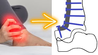 The 4 Ways An Ankle Fusion Can Be Done [upl. by Lori]