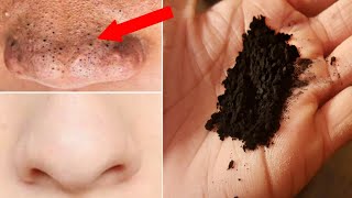 How to Remove Blackheads from Nose  Face Hindi [upl. by Artemis]