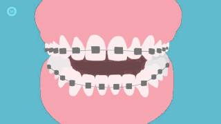 How To Brush Your Teeth With Braces  A Step By Step Guide [upl. by Jacquelynn]