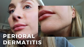 Perioral Dermatitis What to Know Skincare  An Estheticians Experience [upl. by Ydnyc]