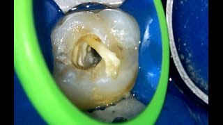 Root canal obturation [upl. by Eneles]