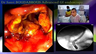 ERCP FOR ACUTE CHOLANGITIS [upl. by Ahsieker]