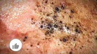 Most Satisfying CloseUp Blackhead Removal 2024 [upl. by Natsyrt443]