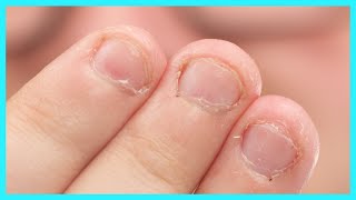 Fix Bitten Nails and Avoid Allergies with My Hack [upl. by Anjanette]