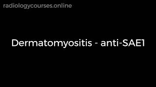 MRI of dermatomyositis anti SAE1 antibody [upl. by Wynny]