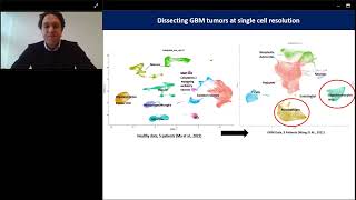 Multivalent RNA CART cell for malignant glioma [upl. by Trauner36]