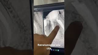 ¿Retratamiento en una cita Si sin dolor satisfying endodoncia odontologia [upl. by Carina581]