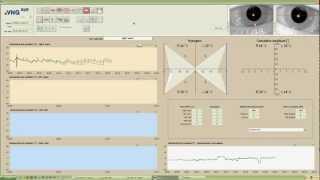 eVNG Caloric Test Demo [upl. by Lairea]