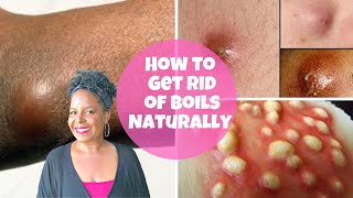 HOW TO GET RID OF BOILS NATURALLY [upl. by Fennie225]