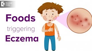 Foods triggering eczema flare up  Help your child avoid the itch  Dr Udhay Sidhu [upl. by Marybella102]