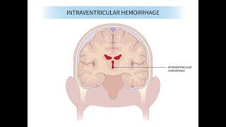 Intraventricular Haemorrhage mrcpch Recall Communication [upl. by Noirret774]