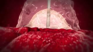 Mynx Ace Vascular Closure Device  Animation [upl. by Aihsram]