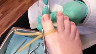 Ingrown toenail surgery [upl. by Yggam269]