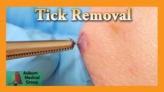 Dead Tick Removal  Auburn Medical Group [upl. by Eillah410]