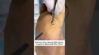 How To Remove Plantar Warts Understanding Treating and Preventing Foot Warts skinaaclinic [upl. by Kerk]