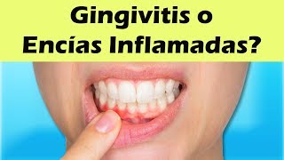 COMO CURAR LA GINGIVITIS Remedios Caseros Para La Gingivitis y Encías Inflamadas [upl. by Oxford]