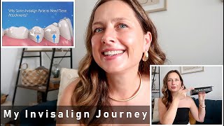 My invisalign journey  How invisalign work  My total dental cost and repayment plan options [upl. by Dranyar]