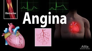 Angina Stable Unstable Microvascular and Prinzmetal Animation [upl. by Otrebla498]