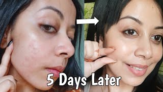 How I Repaired My Skin Barrier in 5 Days At Home Affordable Products skincare [upl. by Jangro]