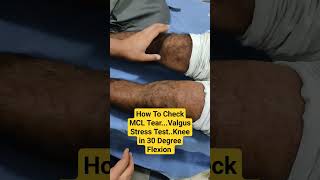 How To Check MCL TearValgus Stress TestKnee in 30 Degree Flexion Dr Sai Chandra [upl. by Dranik]