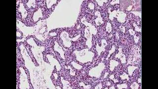 Histopathology Lung Interstitial pneumonia [upl. by Eekram]