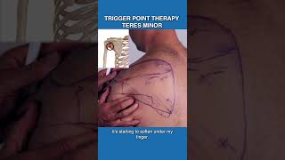 Trapezius trigger point [upl. by Notsuj777]