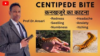 Centipede bite  कनखजुरे का काटना  Redness  Swelling  Numbness  Itching  Headache  Treatment [upl. by Nhguavaj]