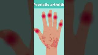 Psoriatic arthritis rheumatology psoriasis ytshort ytytshorts [upl. by Rahcir]