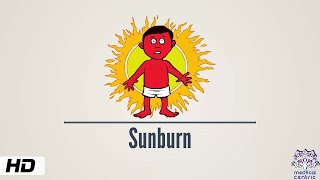 Sunburn Causes Signs and Symptoms Diagnosis and Treatment [upl. by Trill613]