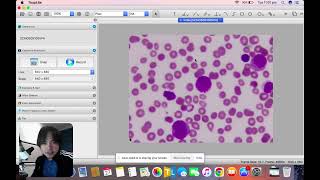 Early myeloid cells discussion part 2 [upl. by Ettennyl]