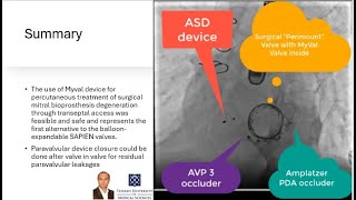 When Mitral Valve in Valve is not enough for Severe Mitral Regurgitation VIV PVL amp ASD closure [upl. by Elleiram]