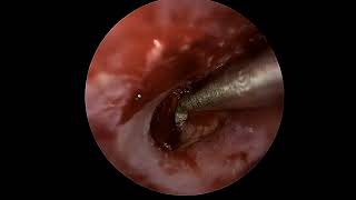 Ear drum repair tympanoplasty with lateral graft [upl. by Eibber901]