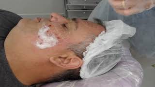 Aula Intradermoterapia pressurizada para melasma masculino [upl. by Remo741]